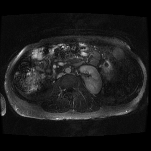 Acinar cell carcinoma of the pancreas (Radiopaedia 75442-86668 Axial T1 C+ fat sat 14).jpg