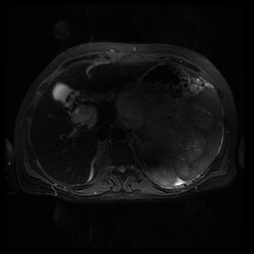 Acinar cell carcinoma of the pancreas (Radiopaedia 75442-86668 Axial T2 fat sat 25).jpg
