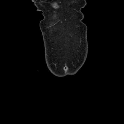 Acinar cell carcinoma of the pancreas (Radiopaedia 75442-86669 Coronal C+ portal venous phase 8).jpg