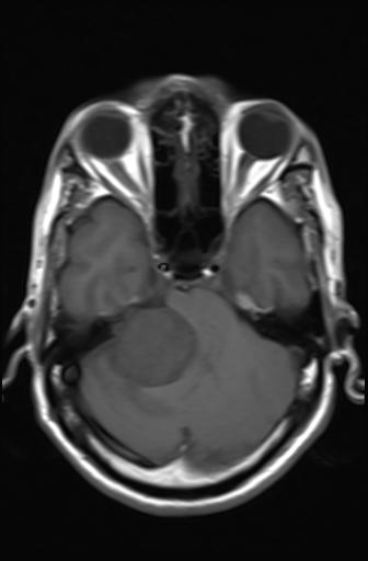 File:Acoustic schwannoma - probable (Radiopaedia 20386-20292 Axial T1 6).jpg