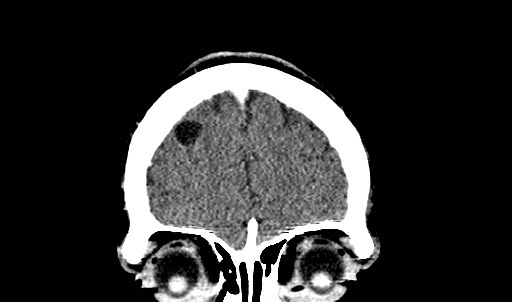 File:Active neurocysticercosis before and after therapy (Radiopaedia 71710-82099 Coronal 57).jpg