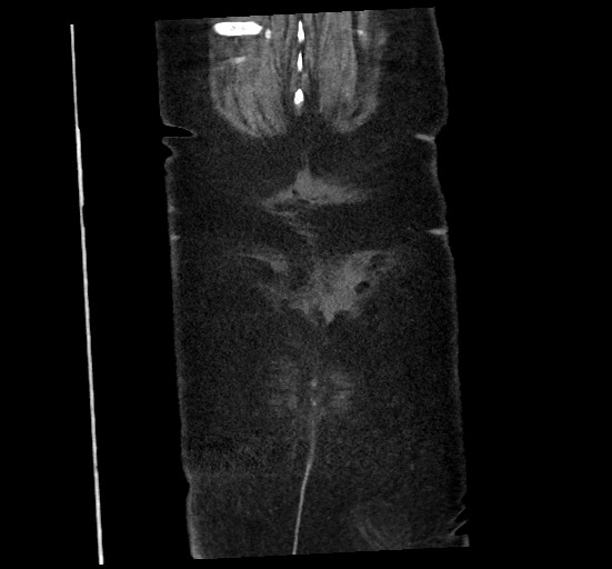 Active renal extravasation with large subcapsular and retroperitoneal hemorrhage (Radiopaedia 60975-68796 Coronal C+ portal venous phase 143).jpg