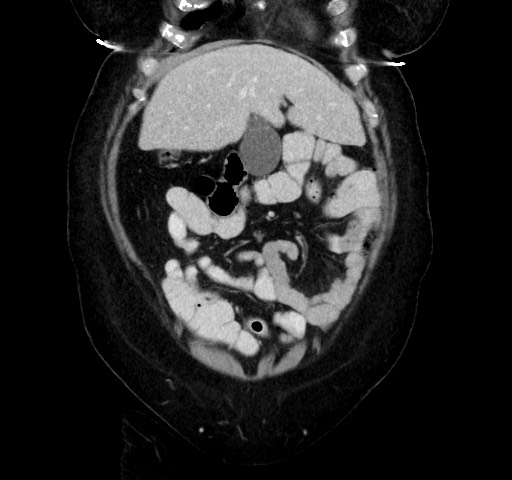 Acute appendicitis, heterotaxy syndrome (Radiopaedia 66884-76202 Coronal C+ portal venous phase 28).jpg