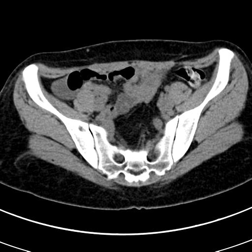 Acute appendicitis (Radiopaedia 30261-30888 Axial non-contrast 78).jpg