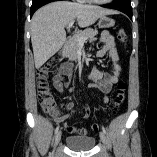 Acute appendicitis (Radiopaedia 38255-40270 Coronal C+ portal venous phase 37).jpg