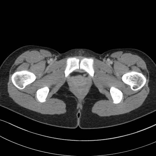 File:Acute appendicitis (Radiopaedia 62608-70901 Axial C+ portal venous phase 67).jpg