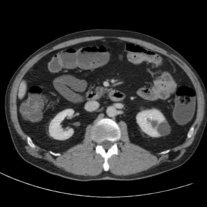 Acute appendicitis (Radiopaedia 66513-75790 Axial C+ portal venous phase 27).jpg
