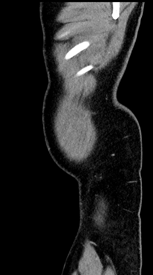 Acute appendicitis (Radiopaedia 77016-88960 Sagittal C+ portal venous phase 6).jpg