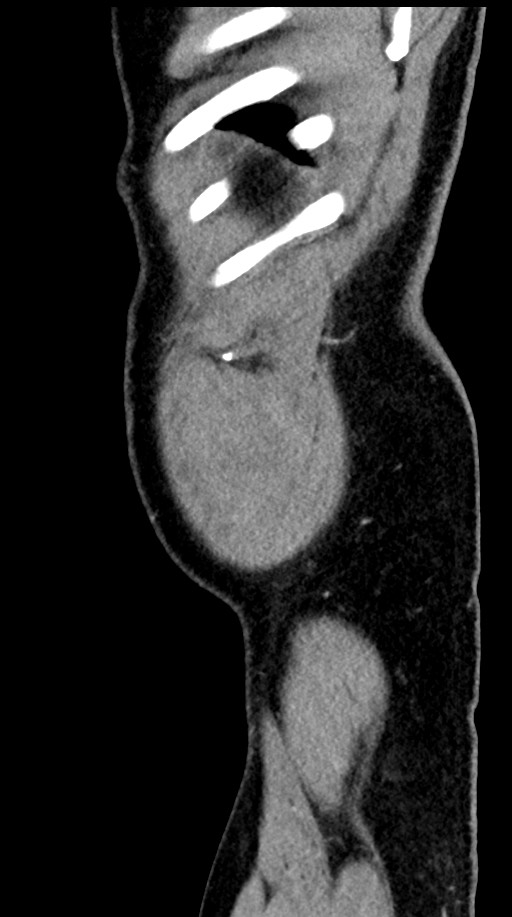 Acute appendicitis (Radiopaedia 77016-88960 Sagittal C+ portal venous phase 8).jpg
