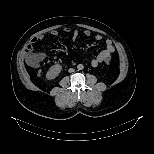 Acute appendicitis (Radiopaedia 79950-93224 Axial non-contrast 56).jpg