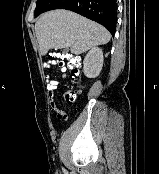 Acute appendicitis (Radiopaedia 84780-100240 Sagittal C+ portal venous phase 24).jpg