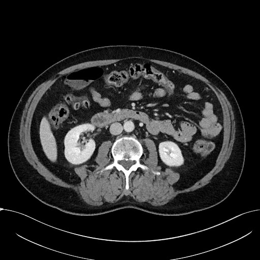 Acute appendicitis - large appendicoliths (Radiopaedia 61805-69820 Axial C+ portal venous phase 61).jpg