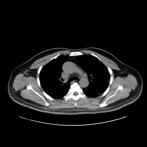 Acute appendicitis and COVID 19 pneumonia (Radiopaedia 76604-88380 Axial non-contrast 20).jpg