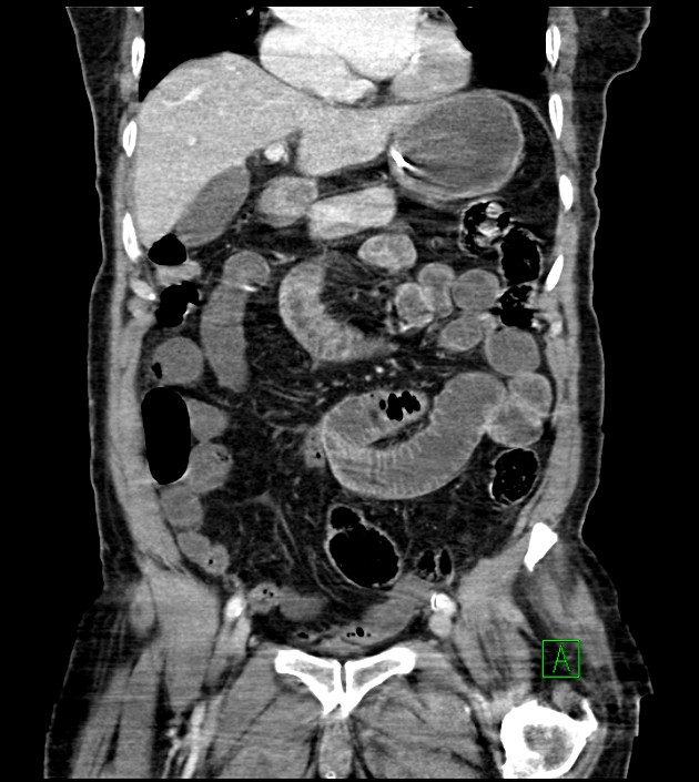 Acute arterial mesenteric ischemia (Radiopaedia 78238-90828 Coronal C+ portal venous phase 41).jpg