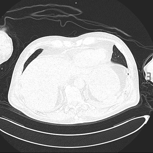 Acute aspiration pneumonitis (Radiopaedia 55642-62166 Axial lung window 130).jpg