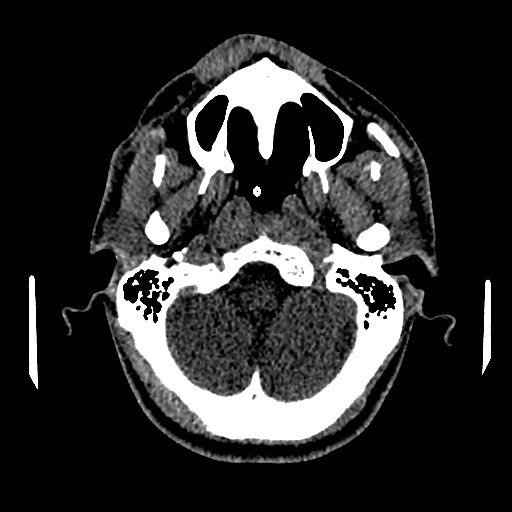 File:Acute basilar artery occlusion (Radiopaedia 43582-46985 Axial non-contrast 38).jpg