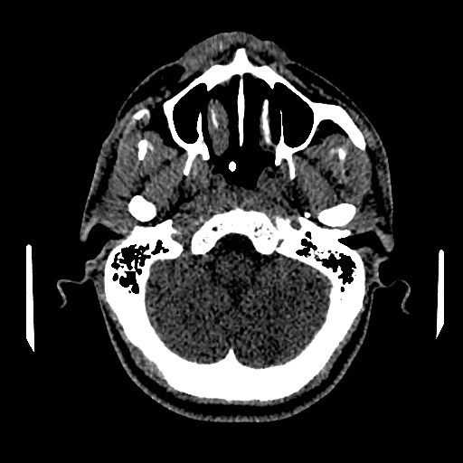 Acute basilar artery occlusion (Radiopaedia 43582-46985 Axial non-contrast 42).jpg