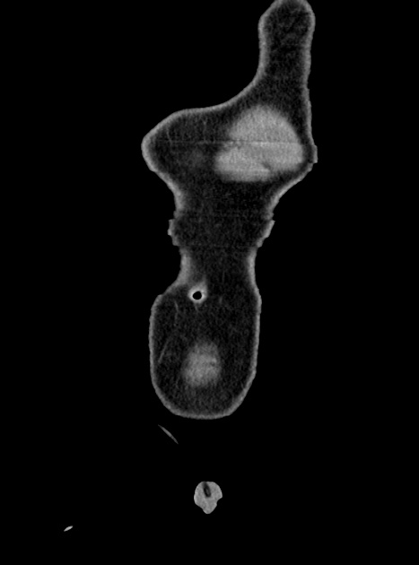 Acute bowel ischemia (Radiopaedia 87695-104114 Coronal C+ portal venous phase 57).jpg