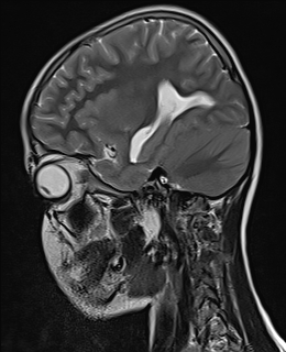 File:Acute cerebellar ataxia (Radiopaedia 61487-69446 Sagittal T2 2).jpg