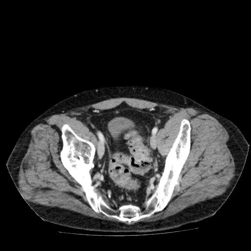 File:Acute cholecystitis and incidental left sided IVC (Radiopaedia 49352-54459 Axial C+ portal venous phase 132).jpg