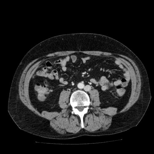 Acute cholecystitis and incidental left sided IVC (Radiopaedia 49352-54459 Axial C+ portal venous phase 88).jpg