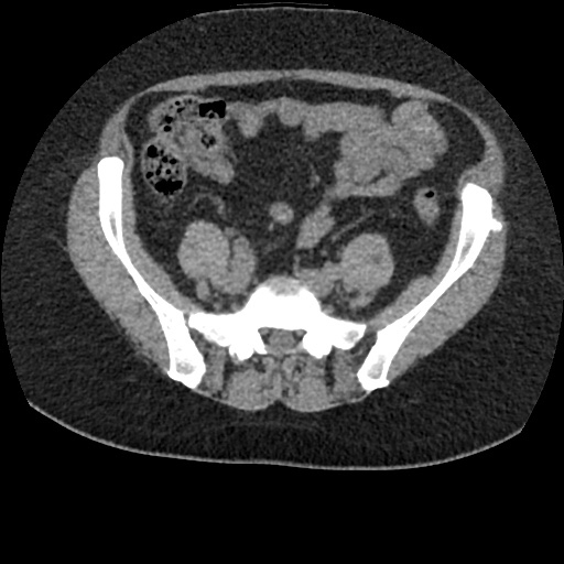 File:Acute cholecystitis and ureteric colic (Radiopaedia 42330-45444 Axial prone 75).jpg