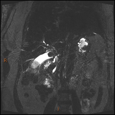 File:Acute cholecystitis with gallbladder neck calculus (Radiopaedia 42795-45971 Coronal Turbo spin echo 16).jpg