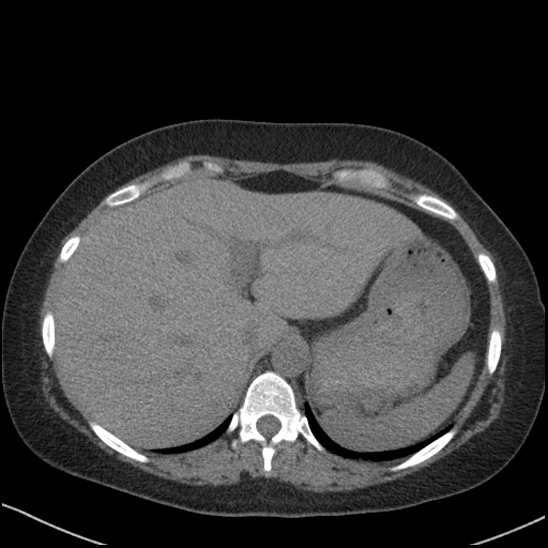Acute colonic hemorrhage in ulcerative colitis (Radiopaedia 77415-89538 Axial non-contrast 24).jpg