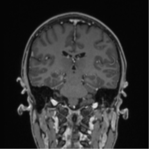 Acute disseminated encephalomyelitis (ADEM) (Radiopaedia 65319-74349 Coronal T1 C+ 18).png