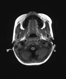 File:Acute disseminating encephalomyelitis with bilateral optic neuritis (Radiopaedia 79676-92886 Axial T1 3).jpg