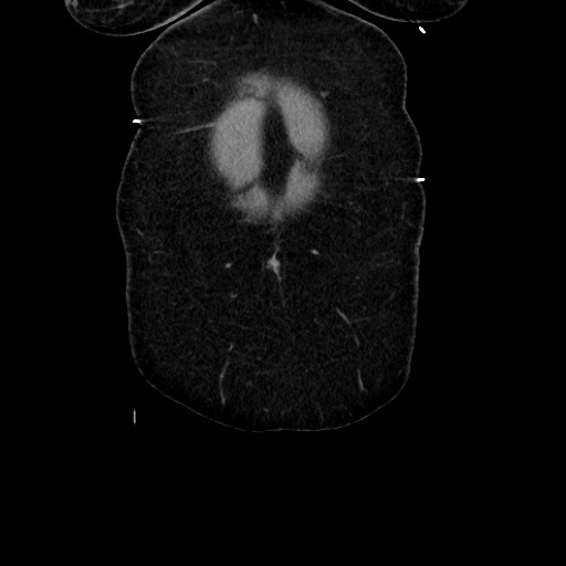 Acute diverticulitis - transverse colon (Radiopaedia 87063-103327 Coronal C+ portal venous phase 31).jpg