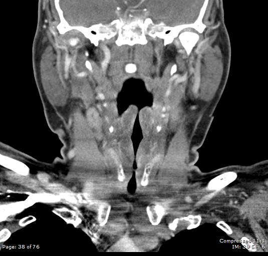 File:Acute epiglottitis (Radiopaedia 54375-60590 Coronal C+ arterial phase 38).jpg