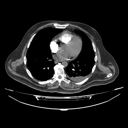 Acute heart failure (CT) (Radiopaedia 79835-93075 Axial C+ arterial phase 25).jpg