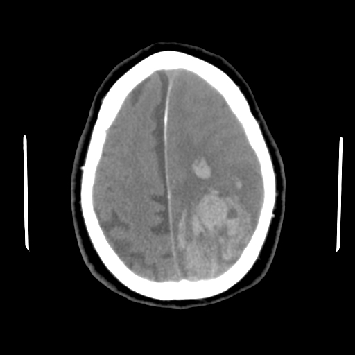 Acute hemorrhagic stroke (Radiopaedia 17507-17223 Axial non-contrast 41).jpg
