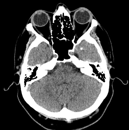 Acute internal carotid artery dissection (Radiopaedia 53541-59558 Axial non-contrast 15).jpg