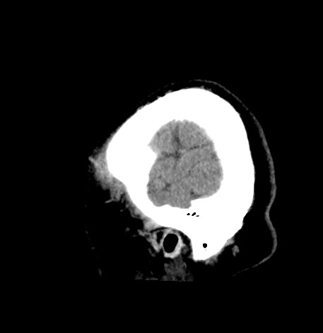 Acute internal carotid artery dissection (Radiopaedia 53541-59558 Sagittal non-contrast 58).jpg
