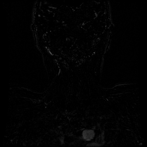 Acute internal carotid artery dissection (Radiopaedia 53541-59632 Coronal MRA 3).jpg