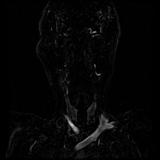 Acute internal carotid artery dissection (Radiopaedia 53541-59632 Coronal MRA 74).jpg
