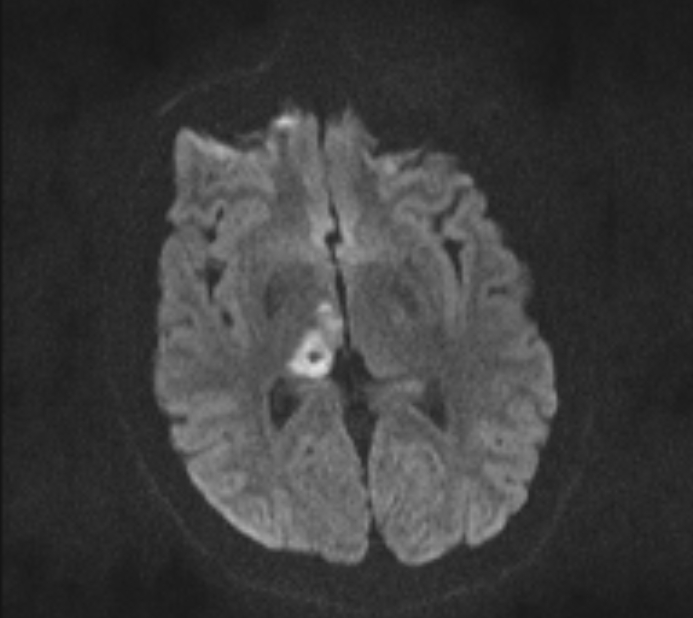 Acute ischemic stroke - posterior circulation territory (Radiopaedia 77670-89880 Axial DWI 58).jpg