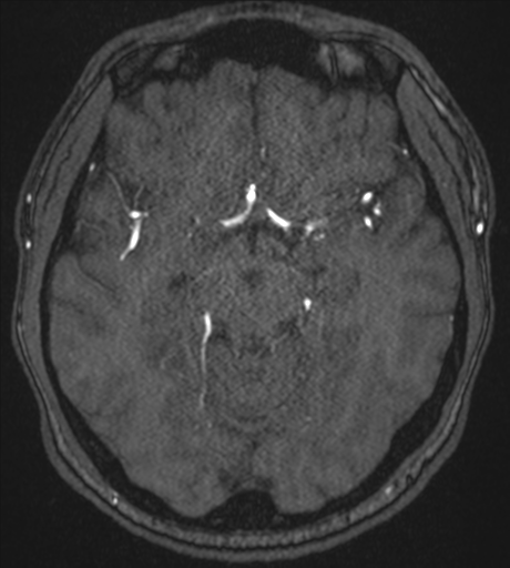 Acute left middle cerebral artery territory infarct with clot retrieval (Radiopaedia 47732-52433 Axial MRA 26).png