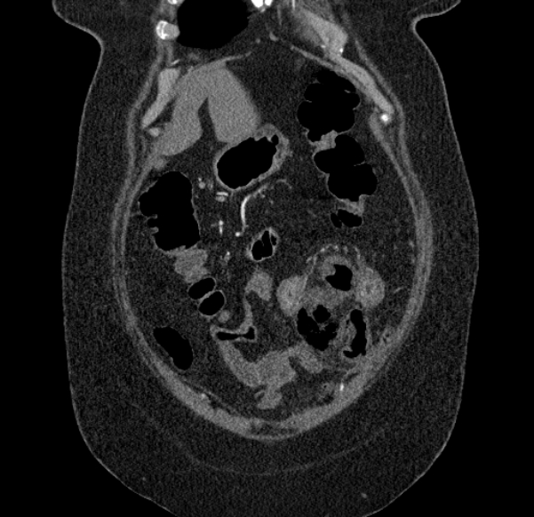 Acute mesenteric ischemia (Radiopaedia 80029-93316 Coronal C+ arterial phase 20).jpg