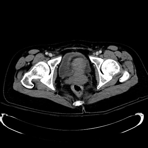 Acute myocardial infarction in CT (Radiopaedia 39947-42415 Axial C+ portal venous phase 130).jpg