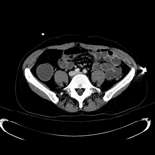 File:Acute myocardial infarction in CT (Radiopaedia 39947-42415 Axial C+ portal venous phase 85).jpg