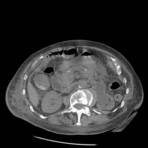 Acute on chronic pancreatitis (Radiopaedia 13233-13244 Axial non-contrast 42).jpg
