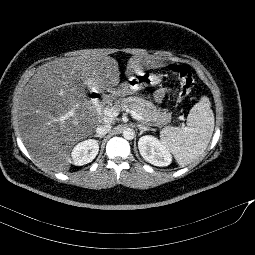 File:Acute on chronic pancreatitis (Radiopaedia 80902-94423 Axial C+ portal venous phase 48).jpg