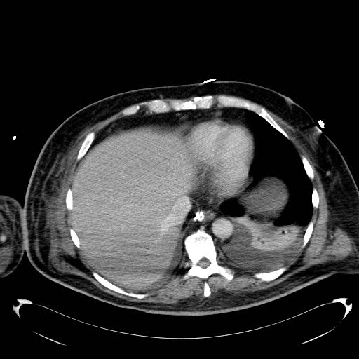 File:Acute pancreatic necrosis (Radiopaedia 13560-18503 Axial C+ portal venous phase 5).jpg