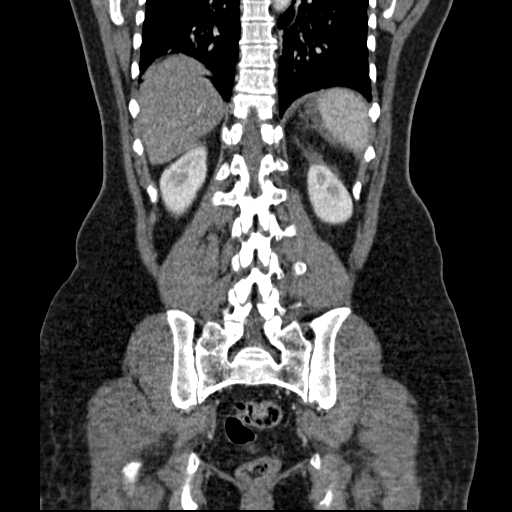 File:Acute pancreatitis (Radiopaedia 20829-20744 Coronal C+ portal venous phase 42).jpg