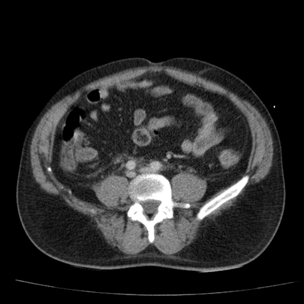 Acute pancreatitis (Radiopaedia 26663-26813 Axial C+ portal venous phase 57).jpg