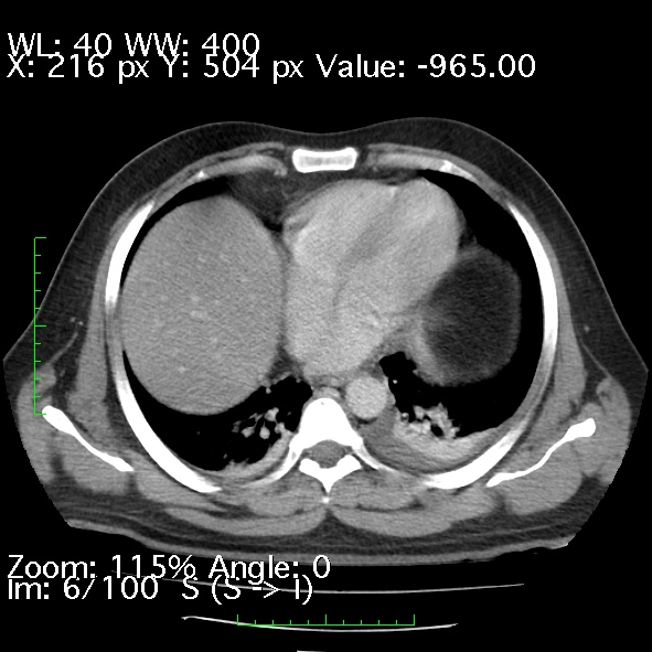 Acute pancreatitis (Radiopaedia 34043-35276 Axial C+ portal venous phase 6).jpg