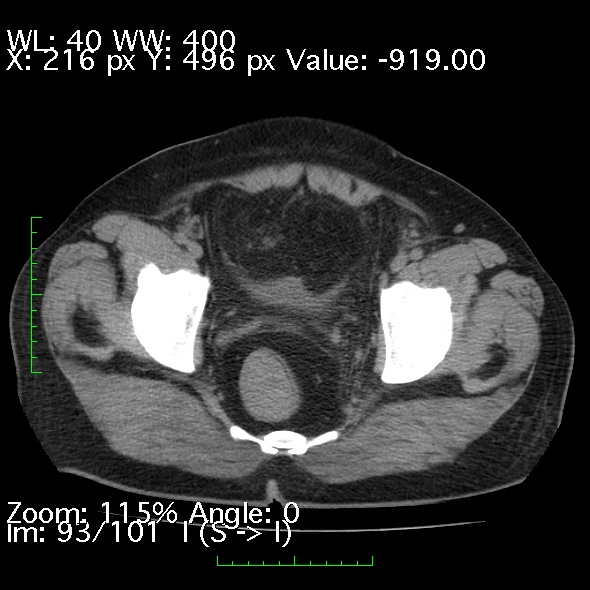 File:Acute pancreatitis (Radiopaedia 34043-35276 Axial non-contrast 93).jpg